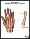 Thumbnail image of: Hand Fracture: Fifth Metacarpal (Boxer's) Fracture, Illustration