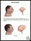 Thumbnail image of: Microcephaly: Illustration