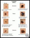 Thumbnail image of: Moles (ABCD): Illustration