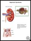 Thumbnail image of: Nephrotic Syndrome: Illustration