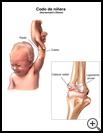 Thumbnail image of: Nursemaid's Elbow: Illustration