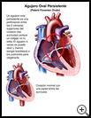 Thumbnail image of: Patent Foramen Ovale: Illustration