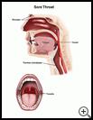 Thumbnail image of: Sore Throat: Illustration
