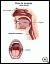 Thumbnail image of: Sore Throat: Illustration