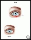 Thumbnail image of: Stye: Illustration