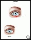 Thumbnail image of: Stye: Illustration