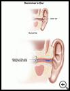 Thumbnail image of: Swimmer's Ear: Illustration