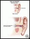 Thumbnail image of: Swimmer's Ear: Illustration