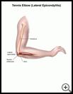Thumbnail image of: Tennis Elbow (Lateral Epicondylitis): Illustration