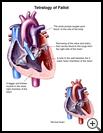 Thumbnail image of: Tetralogy of Fallot: Illustration