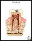 Thumbnail image of: Tooth Decay: Illustration