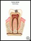 Thumbnail image of: Tooth Decay: Illustration