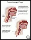 Thumbnail image of: Tracheoesophageal Fistula in Children: Illustration