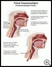 Thumbnail image of: Tracheoesophageal Fistula in Children: Illustration