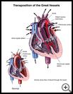 Thumbnail image of: Transposition of the Great Vessels: Illustration