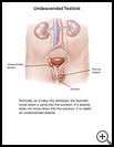 Thumbnail image of: Undescended Testicle: Illustration