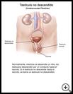 Thumbnail image of: Undescended Testicle: Illustration