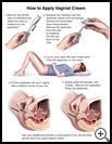 Thumbnail image of: Vaginal Cream, How to Use: Illustration