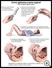 Thumbnail image of: Vaginal Cream, How to Use: Illustration