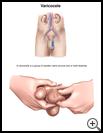 Thumbnail image of: Varicocele (Swollen Veins Around Testicle): Illustration