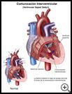 Thumbnail image of: Ventricular Septal Defect: Illustration