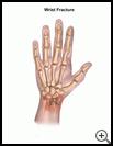 Thumbnail image of: Wrist Fracture: Illustration