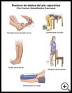 Thumbnail image of: Toe Fracture Exercises: Illustration