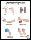 Thumbnail image of: Hand Fracture: Fifth Metacarpal (Boxer's) Fracture Exercises, Illustration