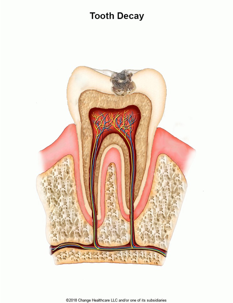 Tooth Decay: Illustration