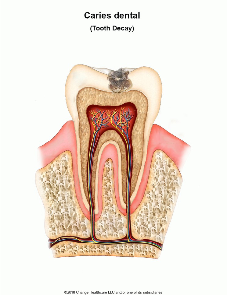 Tooth Decay: Illustration