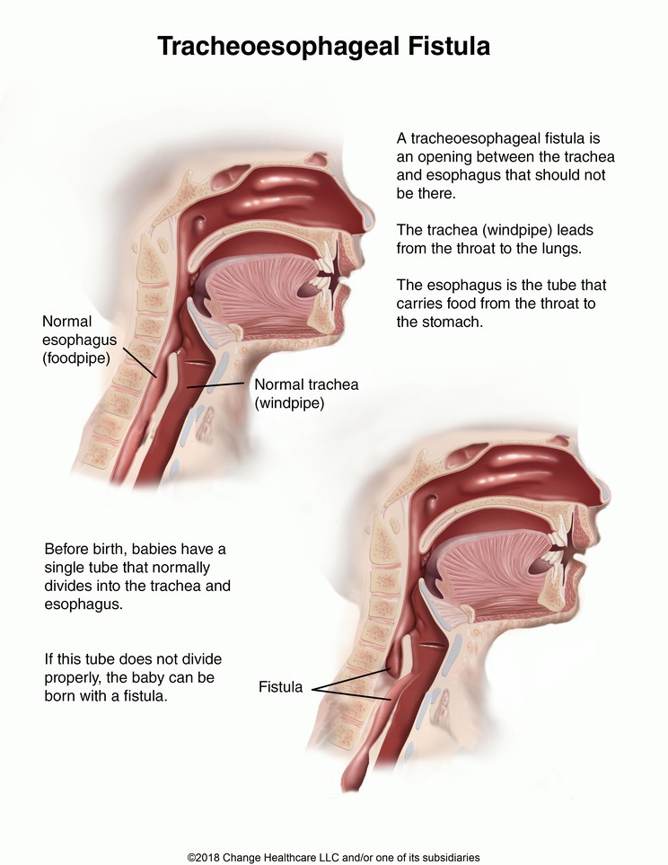 Tracheoesophageal Fistula in Children: Illustration