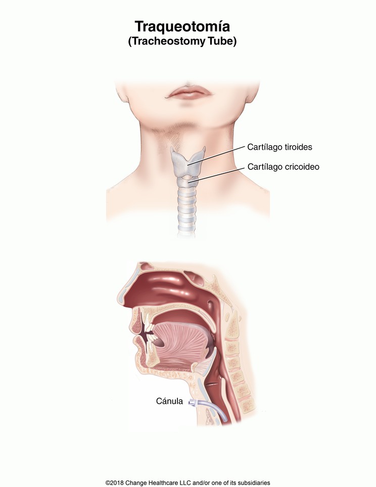 Tracheostomy Tube: Illustration