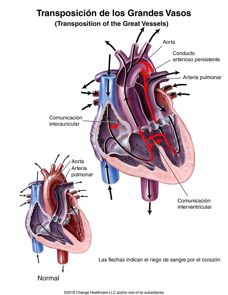 Transposition of the Great Vessels: Illustration