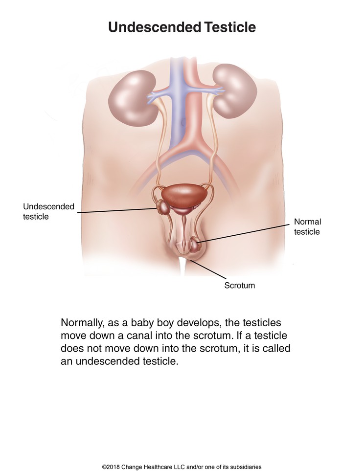 Undescended Testicle: Illustration