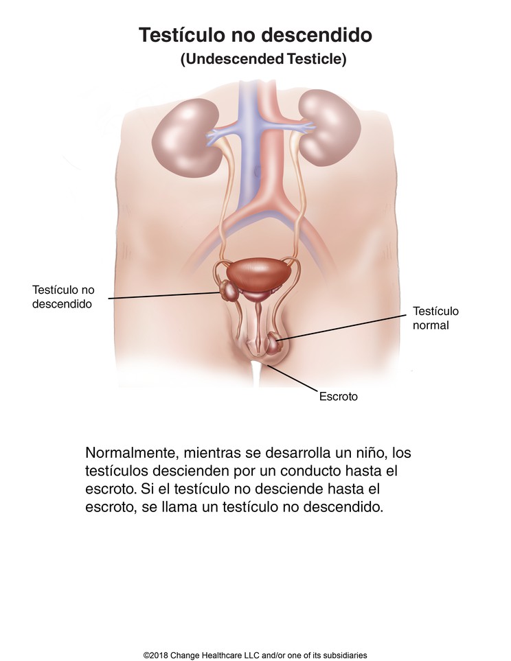 Undescended Testicle: Illustration