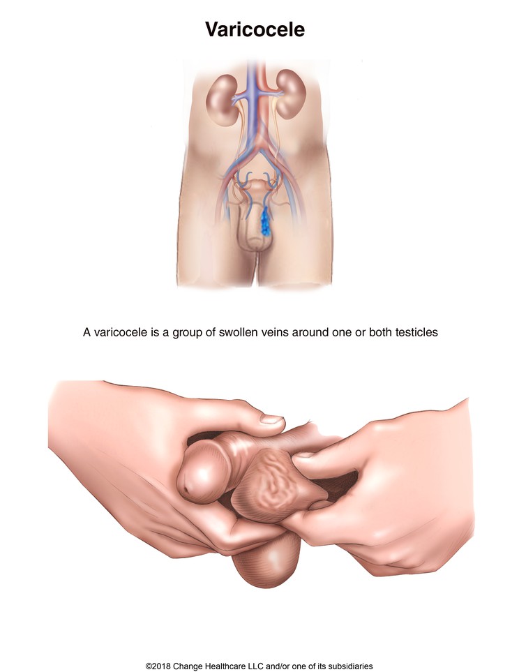 Varicocele (Swollen Veins Around Testicle): Illustration