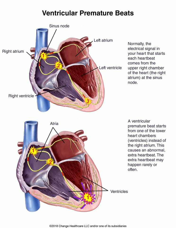 Ventricular Premature Beats: Illustration