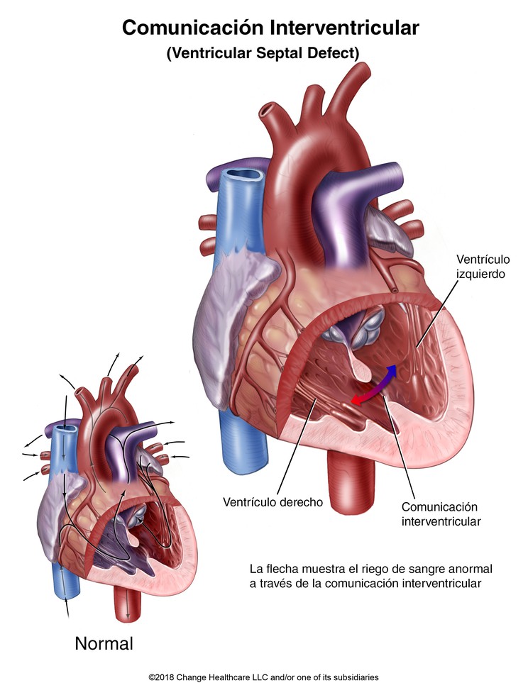 Ventricular Septal Defect: Illustration