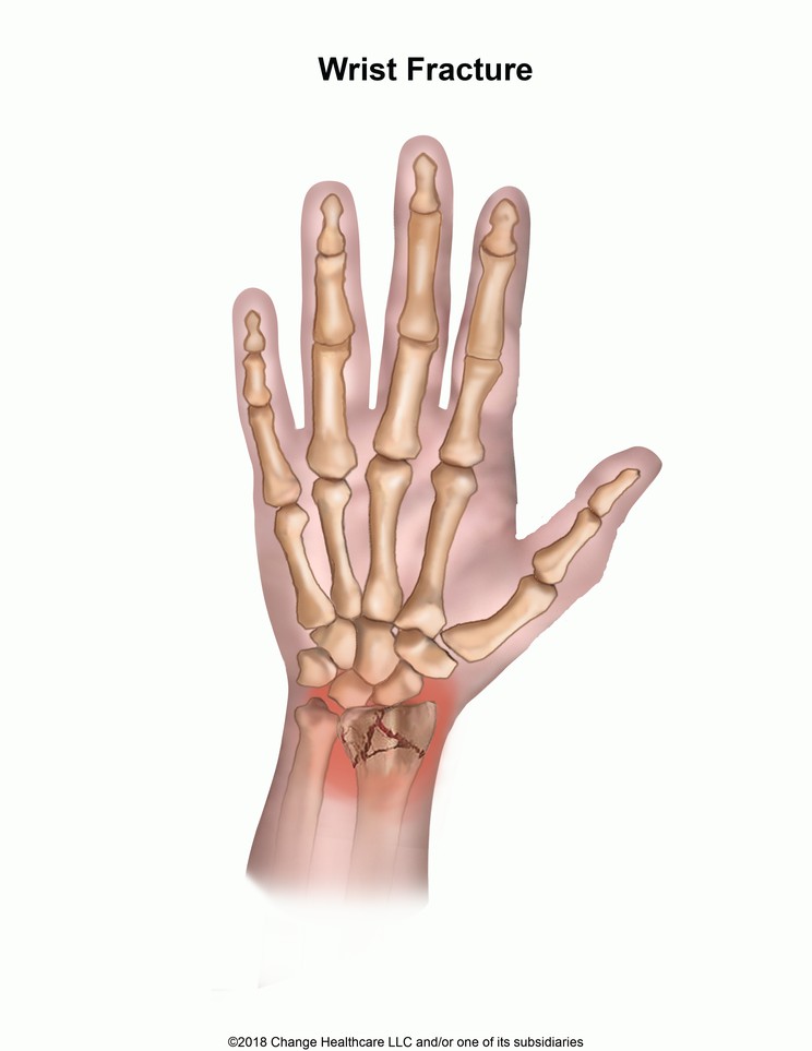 Wrist Fracture: Illustration