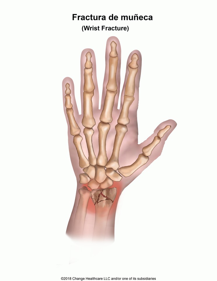 Wrist Fracture: Illustration