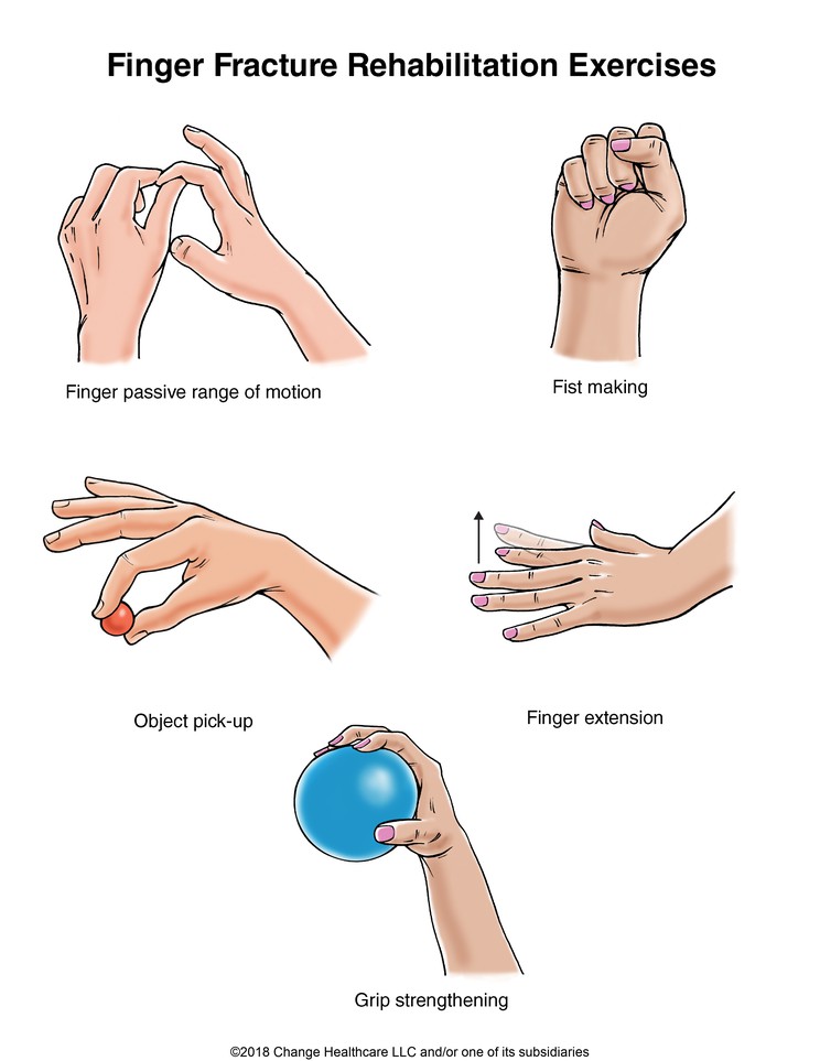 Finger Fracture Exercises: Illustration