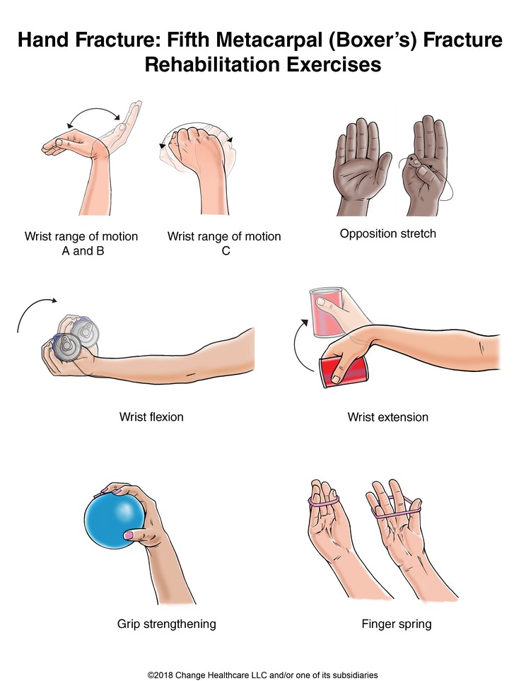 Hand Fracture: Fifth Metacarpal (Boxer's) Fracture Exercises, Illustration