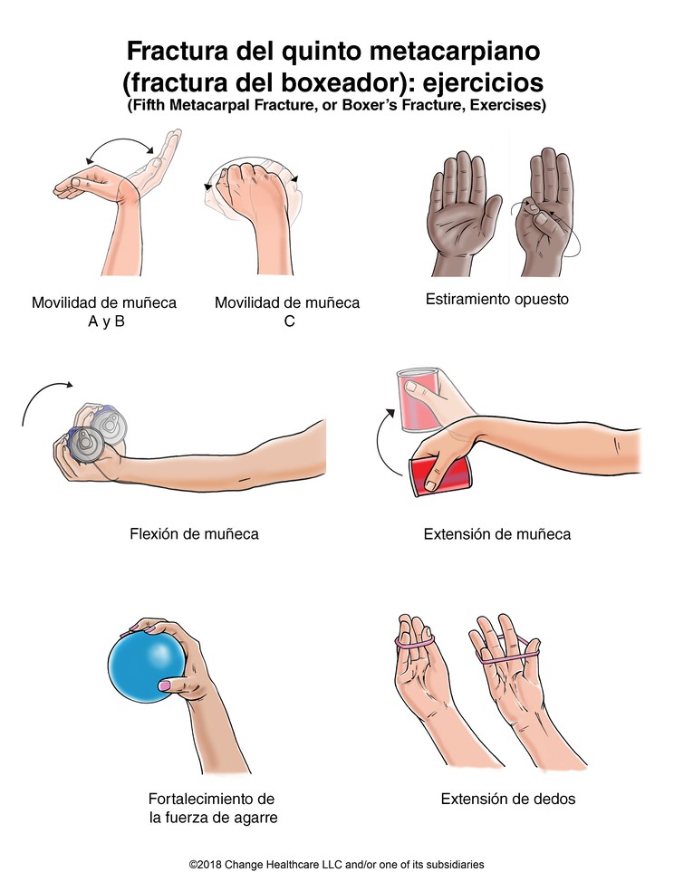 Hand Fracture: Fifth Metacarpal (Boxer's) Fracture Exercises, Illustration